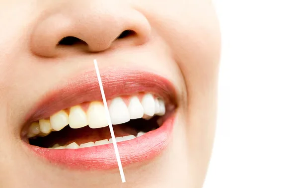 TEETH WHITENING